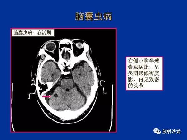 精彩课件讲解——脑囊虫病