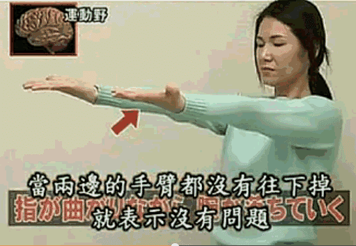 如果双手有一只手往下掉,就要怀疑脑梗的问题.