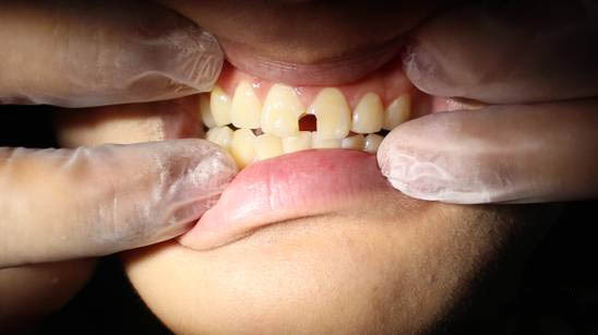 光固化树脂补牙真实案例!