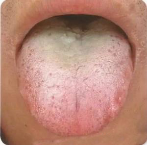 舌头吐露的身体秘密:看看舌头,便知你是哪种体质