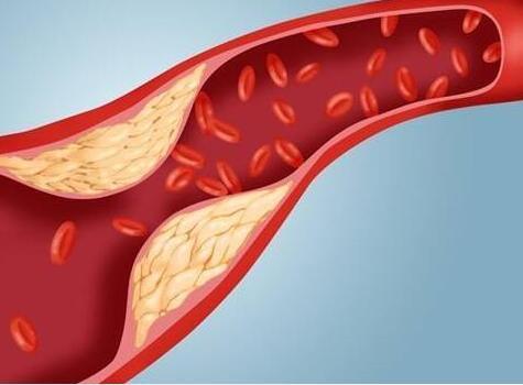 动脉硬化检测的原理是什么_动脉硬化检测(3)