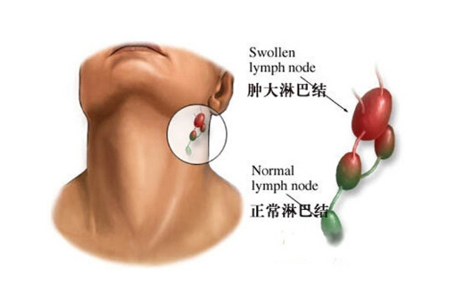 肠性膜淋巴结节高烧图片