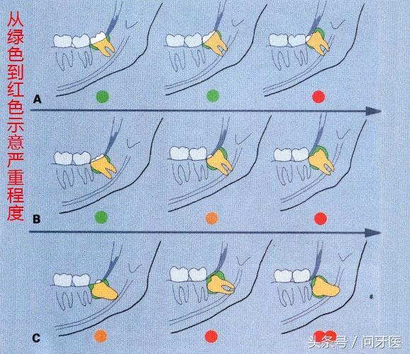 为什么智齿发炎不能马上拔?
