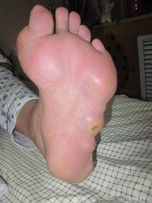 痛风药排名_十大进口痛风药排名(3)