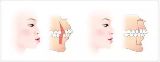 ▼ 详解 牙齿深咬,症状:上颚前牙牙齿重直覆盖了下颚牙
