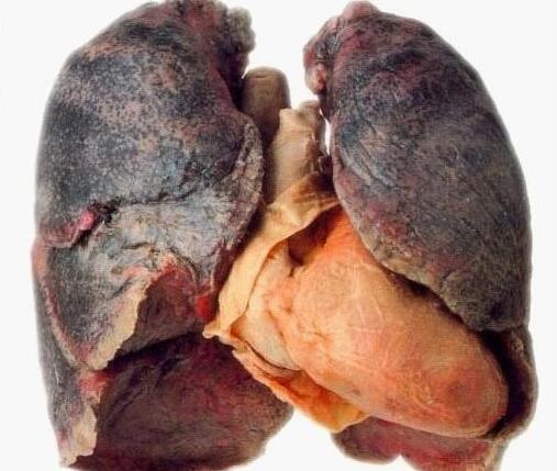 肺癌并不像肝癌那样隐匿,在肺癌早期,或者是即将癌变的时候,肺癌会有
