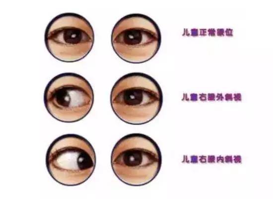 斜视的原因,儿童斜视的原因,眼睛斜视的原因