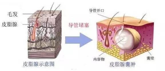 当囊肿皮肤表面有开口时,可以挤出像白色豆腐渣样的东西.