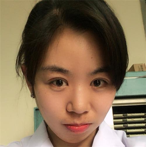韩式三点式双眼皮 好多人见了我都说变了一个人