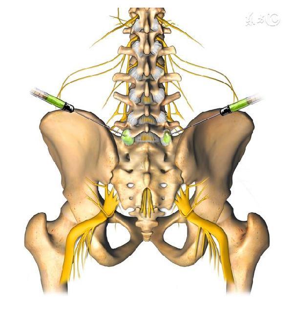 由五个骶椎骨融化而成,嵌夹在骨盆与骨之间,其两侧称为骶髂关节