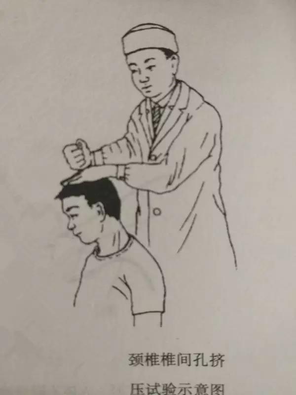 压头试验(又称椎间孔挤压试验,spurling试验):病人端坐,头向病侧侧偏