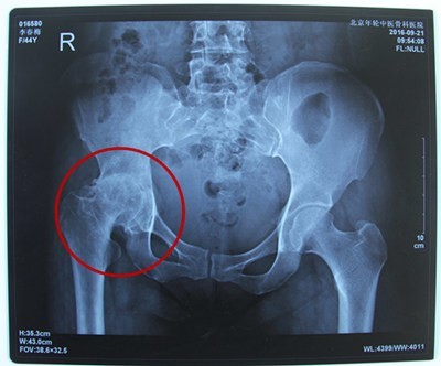 就诊于当地医院,经影像学检查后,被诊断为"右侧股骨头缺血性坏死"