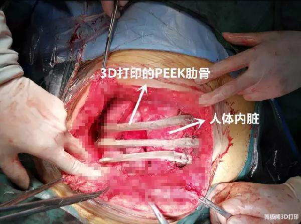 3d打印peek材料超大范围胸壁重建手术,充当了人体的肋骨( 照片有点