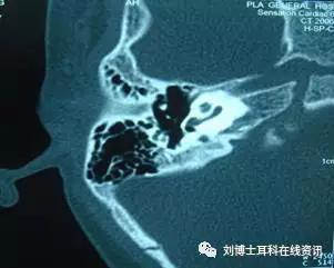 鼓膜紧张部大穿孔(单纯型中耳炎) 鼓膜松弛部穿孔(胆脂瘤) 外耳道肉芽