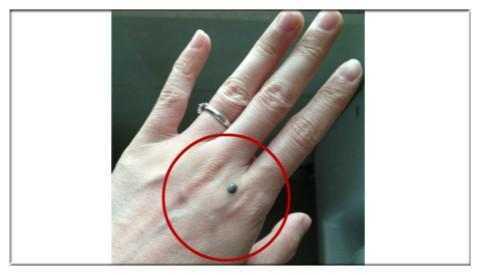 最近,30多岁的何先生到广州某医院就诊,他的右手食指上长了一个黑色的