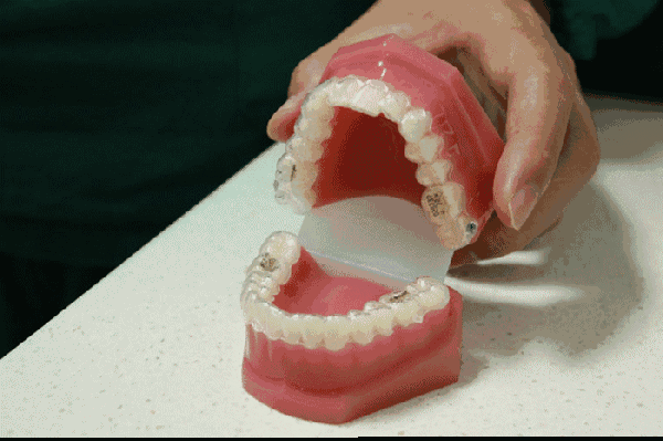 tfboys王俊凯的虎牙是怎么来的?可以拔吗?