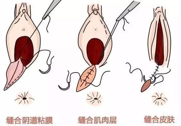 侧切真有那么可怕?其实侧切后处理才是你该关心的