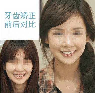 不戴牙套矫正减免12%