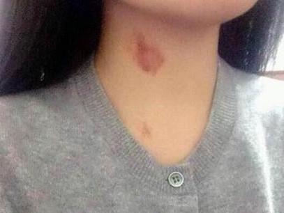 出差回来,看到老婆脖子上的印痕老婆说是蚊子叮的