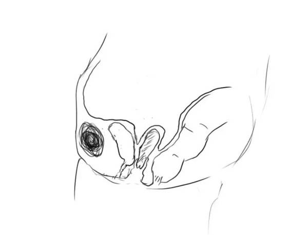 解剖关系清晰,前面膀胱,中间子宫,后面直肠.