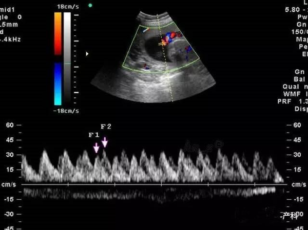 准妈妈的超声报告单之脐血流s/d有什么意义?