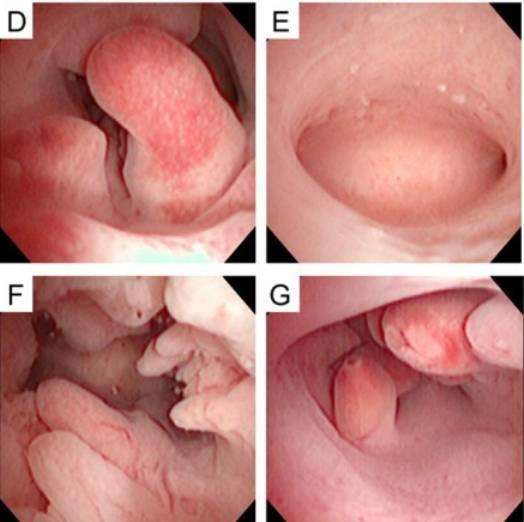 子宫内膜息肉可能影响怀孕:息肉机械性的阻塞输卵管开口影响精子卵子