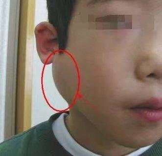 儿童患有腮腺炎则耳垂下方会肿大,肿大的腮腺常呈半球形,以耳垂为中心