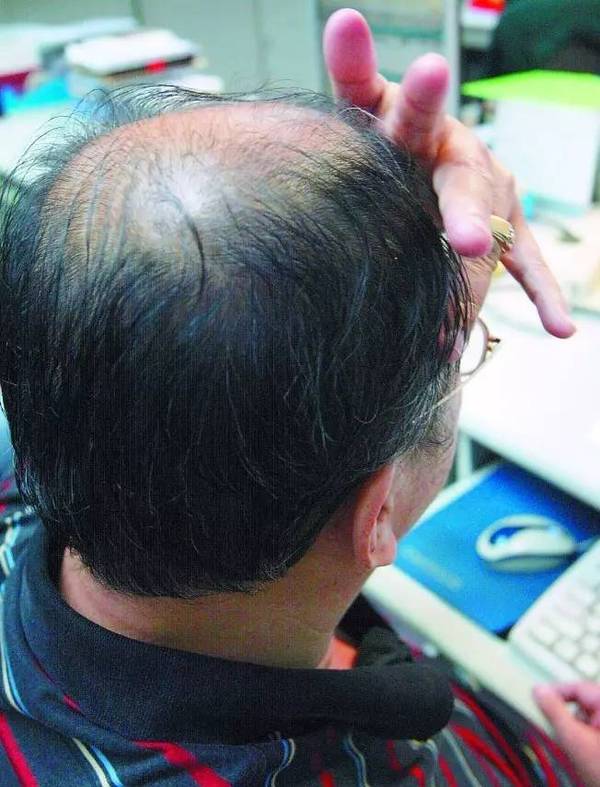 据研究,秃头的人比满头浓密头发的人更长寿.(资料照片)
