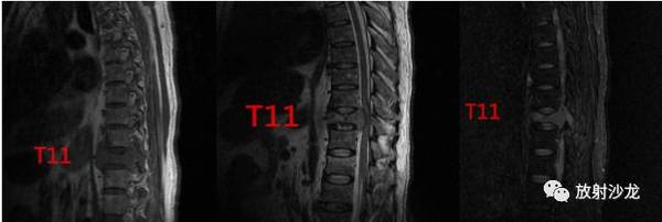 单个椎体病变,你诊断对了吗?