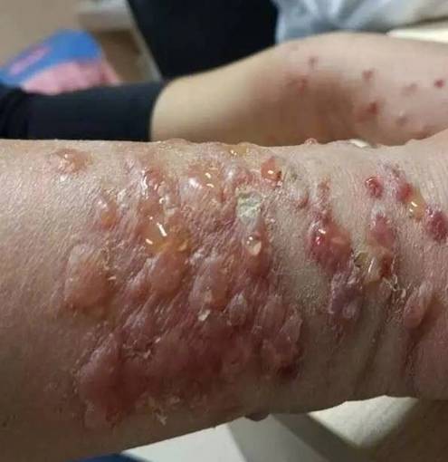 26岁女孩随手拍了下虫子……一觉醒来差点吓死