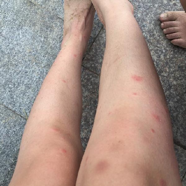 被蚂蚁咬了一下,胳膊肿好厉害.然后一只手都麻了,是怎么回事啊?