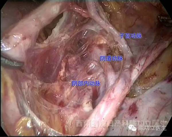 这里可以看见髂内动脉前干的主要分支:膀胱上动脉,子宫动脉,阴道动脉