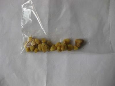 双肾小结晶 搜狐网