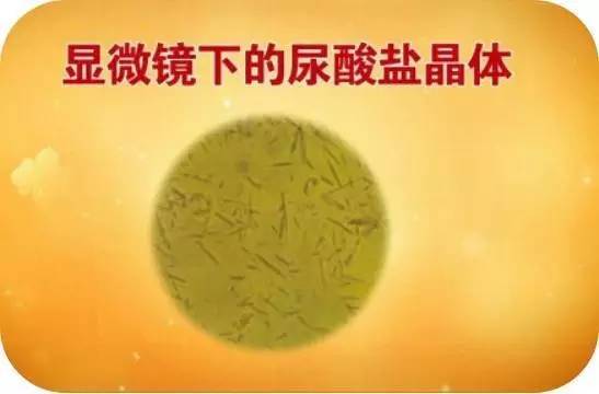 高尿酸不仅仅引发痛风,不小心也会要了你的命(附最全食物中嘌呤含量