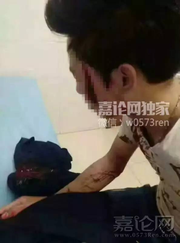 慎点!为一句道歉,嘉兴小伙肩,脸部被砍好几刀,伤口大到医院都不敢缝
