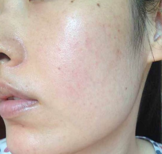 独家:激素脸怎样排毒修复治疗,可以消除激素脸?