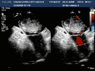 左心房巨大粘液瘤,随心动周期往返于二尖瓣口 三