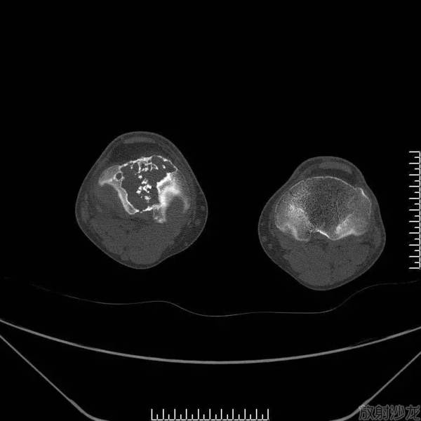 经典病例 | 软骨母细胞型骨肉瘤