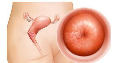 宫颈癌排名_宫颈癌早期症状图片(2)