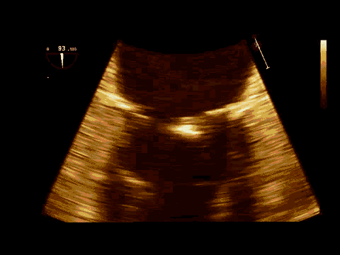 图 2-5 病例五:心尖四腔心切面显示附壁血栓形成