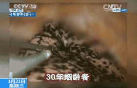 触目惊心,看看15年和30年烟龄者的肺(动态图!你还吸烟吗?