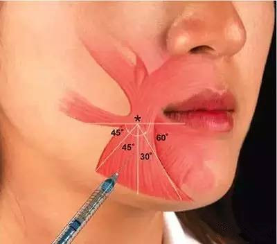 精准,容易引起两边不对称,进针太深会则会将肉毒素注射到降下唇肌前部