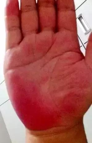 手有红青紫黄褐白黑不同颜色代表不同的病
