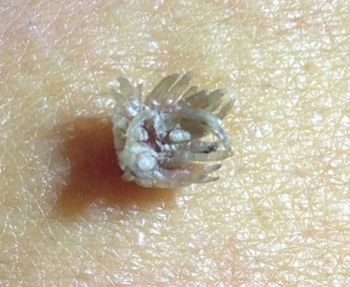 身上长瘊子怎么治疗 图片合集