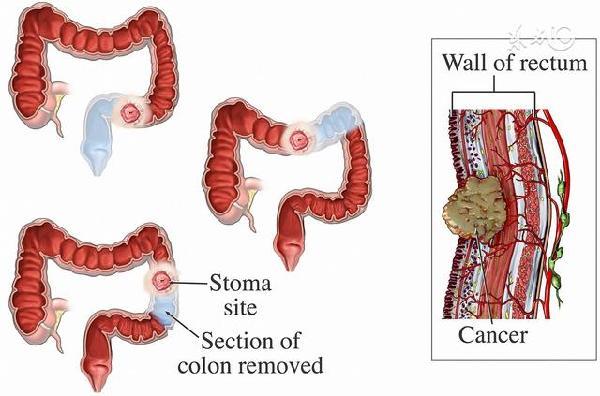 警惕直肠癌的5个危险信号
