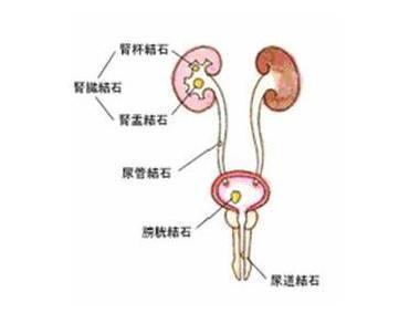 输尿管结石不能盲目,得找专家