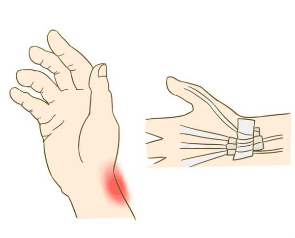 腱鞘炎的症状及治疗方法