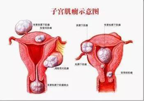 子宫肌瘤算是轻症疾病 子宫肌瘤保险中算轻症吗