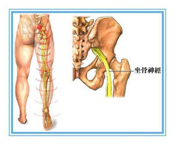 通常表现为抬腿无力,大腿前方或内侧皮肤感觉迟钝:还有些腰5/骶1椎间