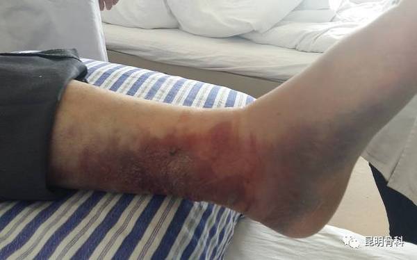 中年男子骨折后用药不对症,左脚惨遭"毒害"苦不堪言